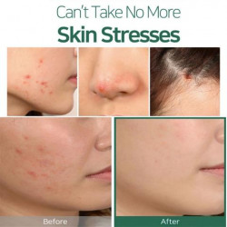 زيت شجرة الشاي المعجزة من سوم باي مي