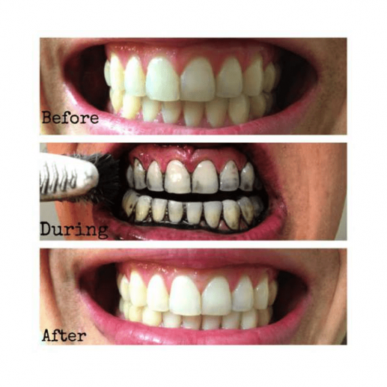 ليزر وايت مسحوق الفحم الأسود لتبييض الاسنان- 20 جرام