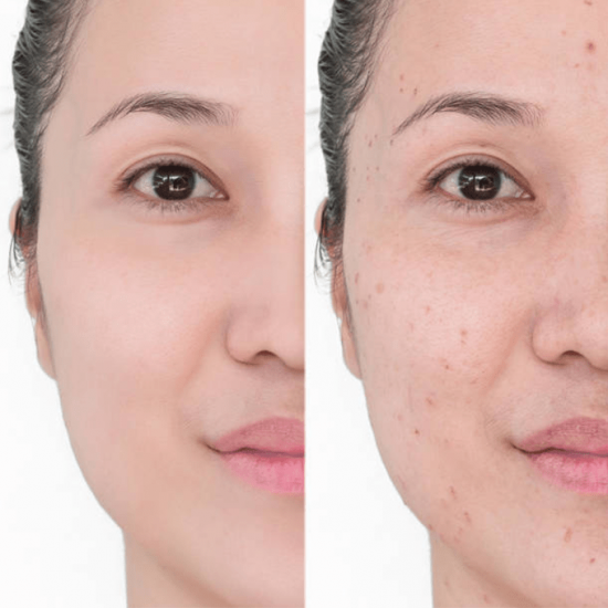 كريم اكرتين 0.25% لعلاج حب الشباب - 30جرام