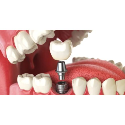 زراعة اسنان